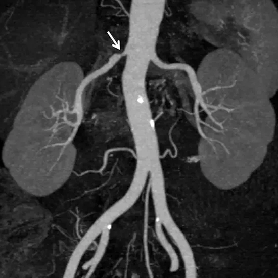 mr angiography renal